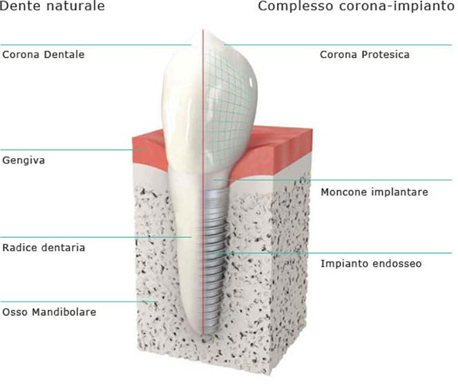 Implantologia denti a Brindisi - Centro Odontoiatrico Atena